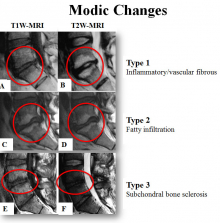 Modic Changes encompass 3 different types: Type I indicates marrow edema in endplate disruption and vascular granulation tissue; Type II indicates fatty degeneration of the vertebral marrow; and Type III indicates subchondral bone sclerosis.